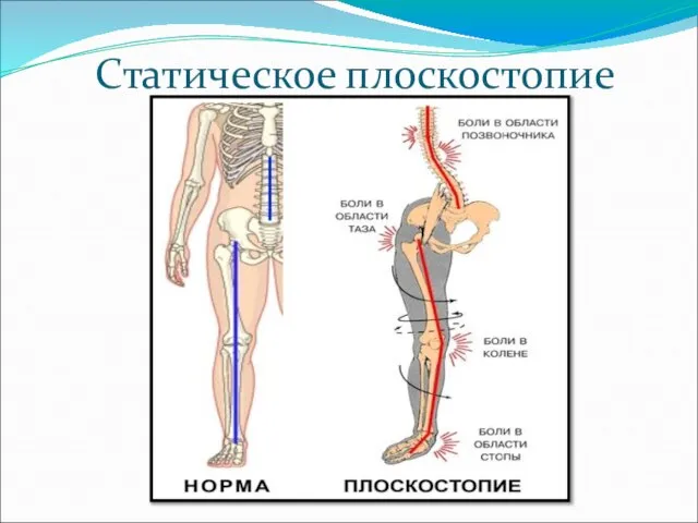 Статическое плоскостопие