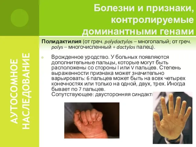 АУТОСОМНОЕ НАСЛЕДОВАНИЕ Полидактилия (от греч. polydactylos – многопалый; от греч. polys –