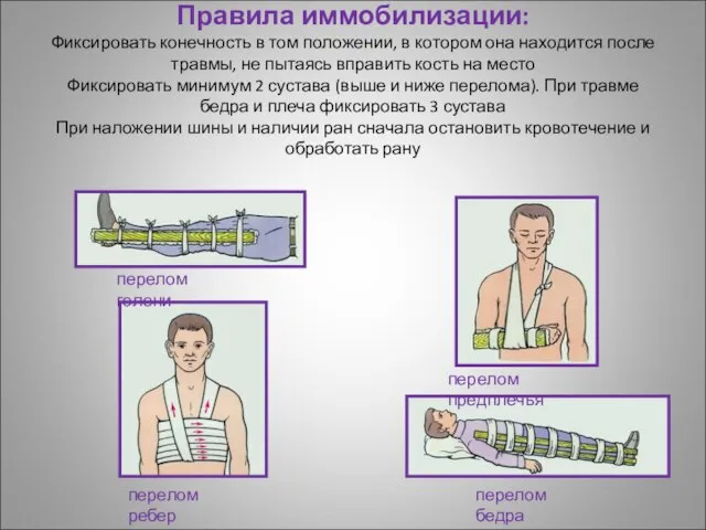 Правила иммобилизации: Фиксировать конечность в том положении, в котором она находится после