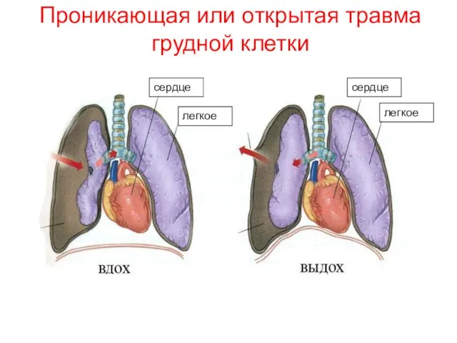 Проникающая или открытая травма грудной клетки сердце легкое легкое сердце