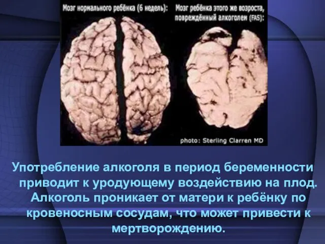 Употребление алкоголя в период беременности приводит к уродующему воздействию на плод. Алкоголь