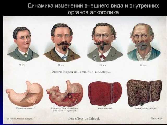 Динамика изменений внешнего вида и внутренних органов алкоголика