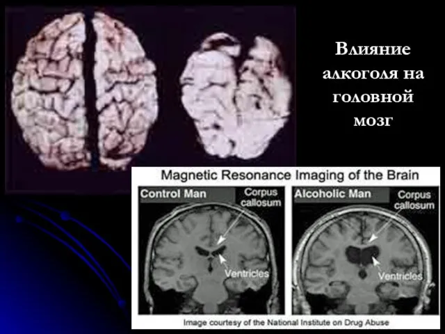 Влияние алкоголя на головной мозг