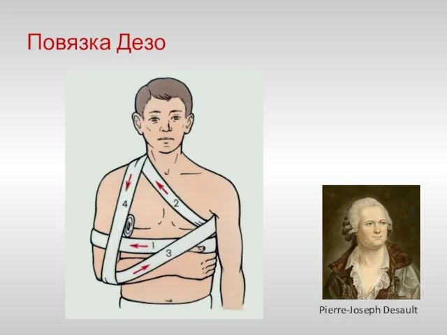 Повязка Дезо Pierre-Joseph Desault