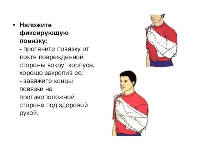 Наложите фиксирующую повязку: - протяните повязку от локтя поврежденной стороны вокруг корпуса,