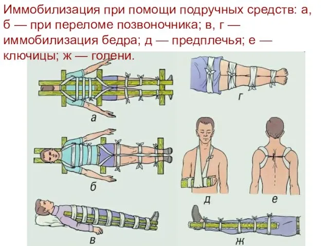 Иммобилизация при помощи подручных средств: а, б — при переломе позвоночника; в,