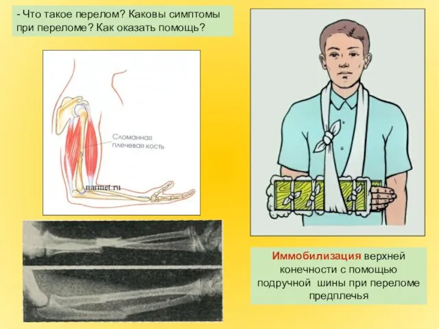 Иммобилизация верхней конечности с помощью подручной шины при переломе предплечья - Что