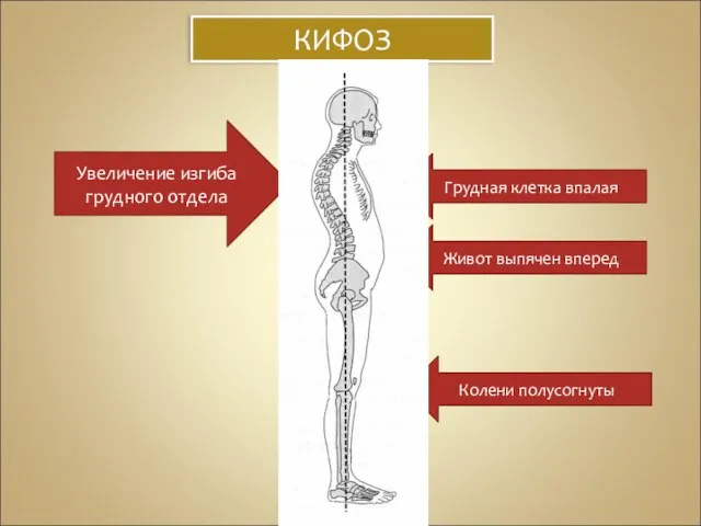 КИФОЗ Грудная клетка впалая Живот выпячен вперед Колени полусогнуты Увеличение изгиба грудного отдела