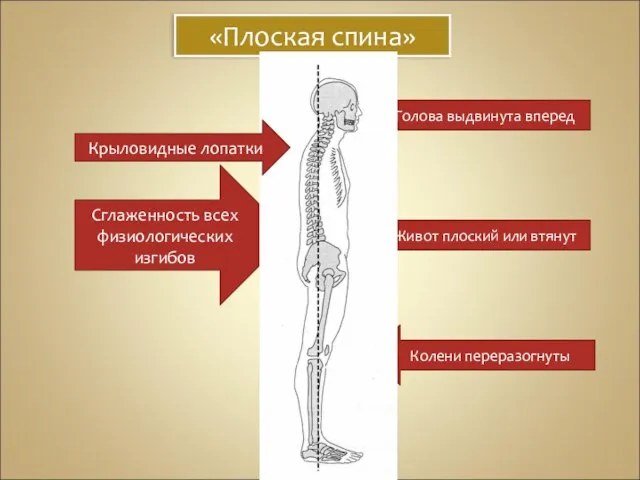 «Плоская спина» Голова выдвинута вперед Живот плоский или втянут Колени переразогнуты Сглаженность