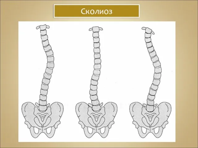 Сколиоз