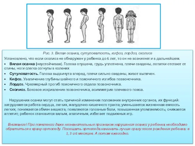 Рис. 3. Вялая осанка, сутуловатость, кифоз, лордоз, сколиоз Установлено, что если сколиоз