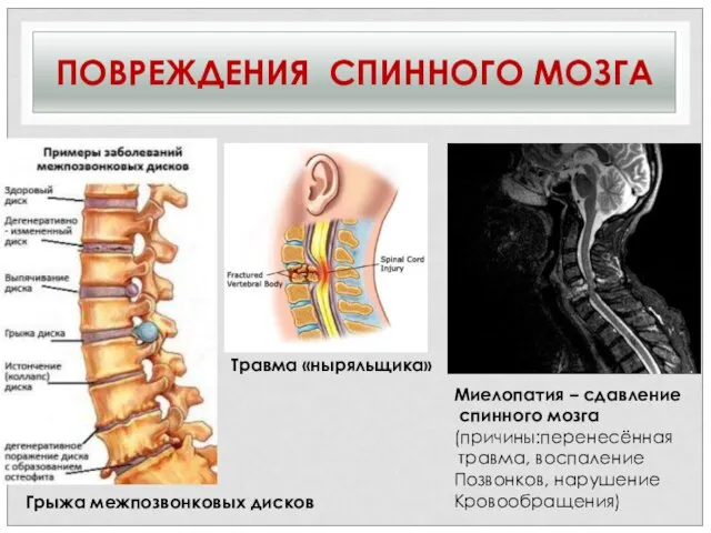 ПОВРЕЖДЕНИЯ СПИННОГО МОЗГА Травма «ныряльщика» Миелопатия – сдавление спинного мозга (причины:перенесённая травма,