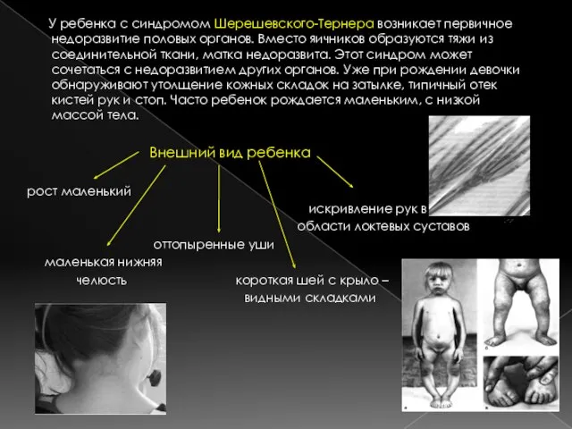 У ребенка с синдромом Шерешевского-Тернера возникает первичное недоразвитие половых органов. Вместо яичников