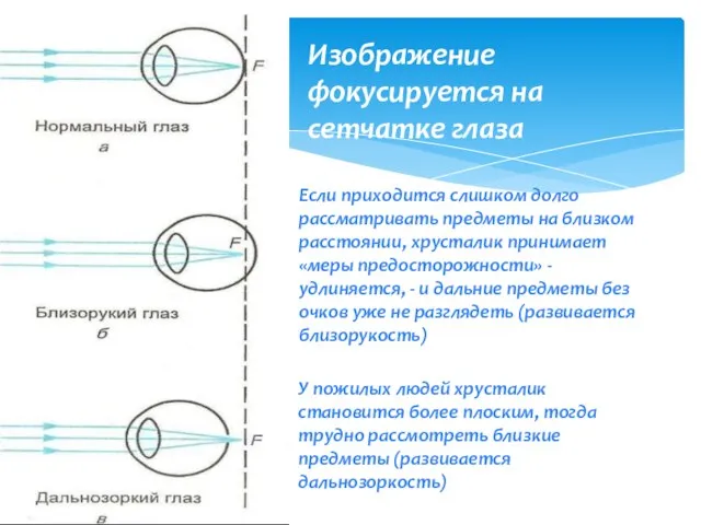 Изображение фокусируется на сетчатке глаза Если приходится слишком долго рассматривать предметы на