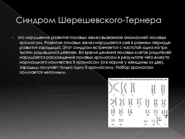 Синдром Шерешевского-Тернера - это нарушение развития половых желез вызванное аномалией половых хромосом.