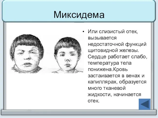 Миксидема Или слизистый отек, вызывается недостаточной функций щитовидной железы. Сердце работает слабо,