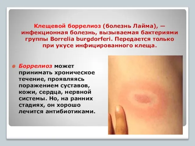 Клещевой боррелиоз (болезнь Лайма), — инфекционная болезнь, вызываемая бактериями группы Borrelia burgdorferi.