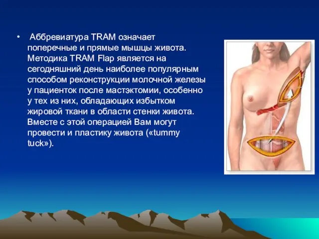 Аббревиатура TRAM означает поперечные и прямые мышцы живота. Методика TRAM Flap является