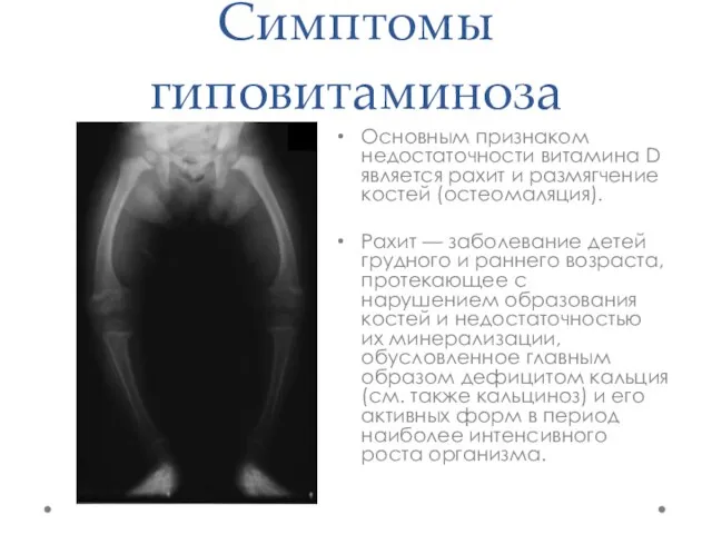Симптомы гиповитаминоза Основным признаком недостаточности витамина D является рахит и размягчение костей