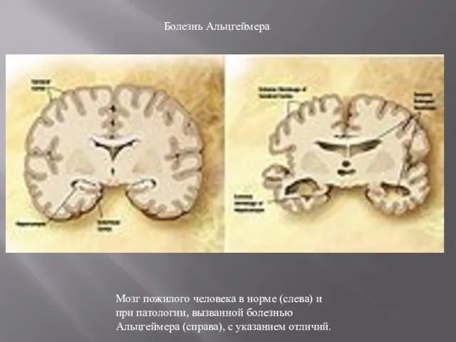 Мозг пожилого человека в норме (слева) и при патологии, вызванной болезнью Альцгеймера
