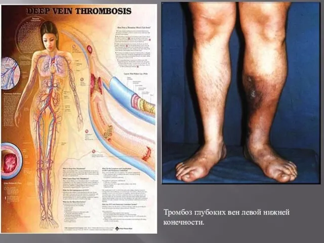 Тромбоз глубоких вен левой нижней конечности.