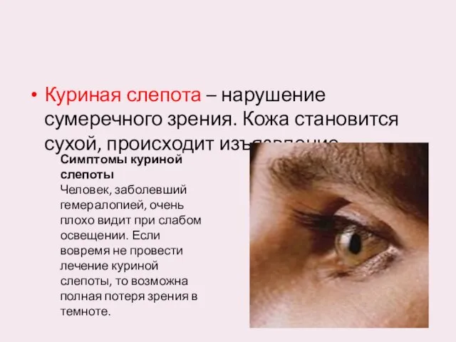 Куриная слепота – нарушение сумеречного зрения. Кожа становится сухой, происходит изъязвление .