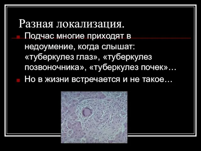 Разная локализация. Подчас многие приходят в недоумение, когда слышат: «туберкулез глаз», «туберкулез