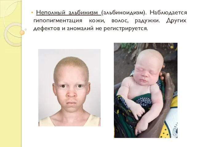 Неполный альбинизм (альбиноидизм). Наблюдается гипопигментация кожи, волос, радужки. Других дефектов и аномалий не регистрируется.