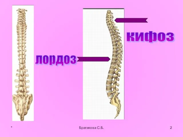 лордоз кифоз * Братякова С.Б.