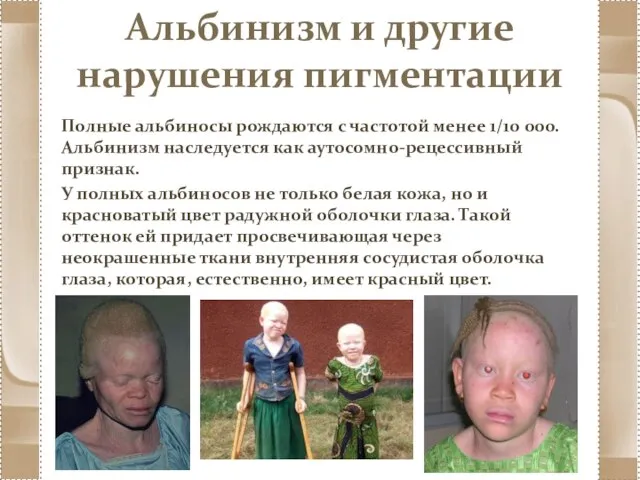 Альбинизм и другие нарушения пигментации Полные альбиносы рождаются с частотой менее 1/10