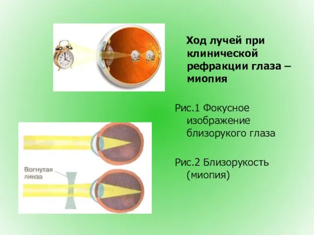 Ход лучей при клинической рефракции глаза – миопия Рис.1 Фокусное изображение близорукого глаза Рис.2 Близорукость (миопия)