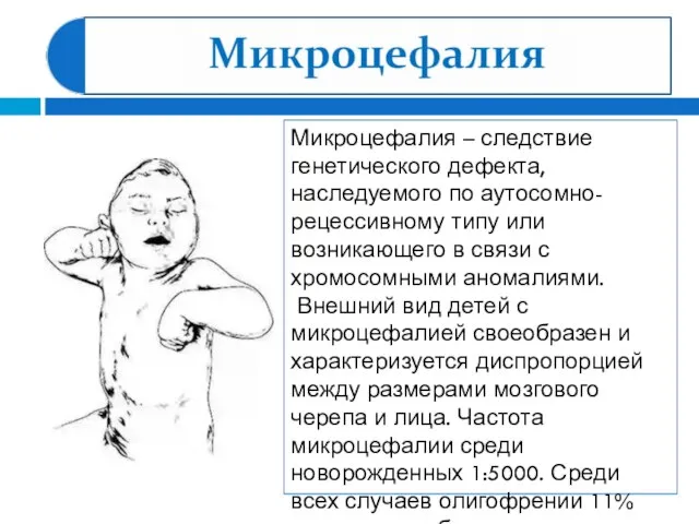 Микроцефалия – следствие генетического дефекта, наследуемого по аутосомно-рецессивному типу или возникающего в