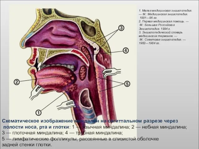 Схематическое изображение миндалин на сагиттальном разрезе через полости носа, рта и глотки: