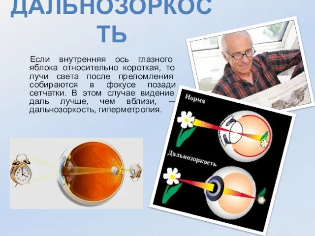 Дальнозоркость Если внутренняя ось глазного яблока относительно короткая, то лучи света после