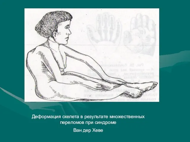 Деформация скелета в результате множественных переломов при синдроме Ван дер Хеве