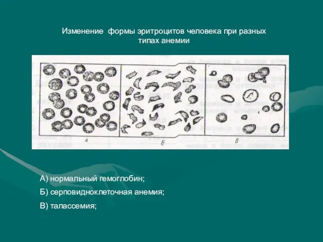 Изменение формы эритроцитов человека при разных типах анемии А) нормальный гемоглобин; Б) серповидноклеточная анемия; В) талассемия;