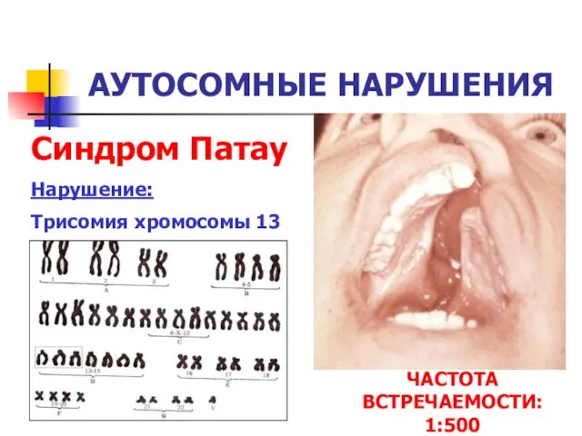 АУТОСОМНЫЕ НАРУШЕНИЯ Синдром Патау Нарушение: Трисомия хромосомы 13 ЧАСТОТА ВСТРЕЧАЕМОСТИ: 1:500