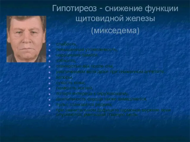 Гипотиреоз - снижение функции щитовидной железы (микседема) слабость, повышенная утомляемость, нарушения памяти,