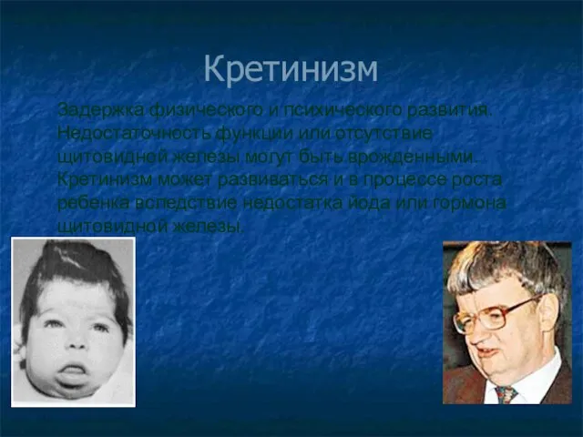 Кретинизм Задержка физического и психического развития. Недостаточность функции или отсутствие щитовидной железы