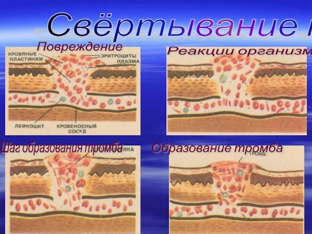 Реакции организма Свёртывание крови Шаг образования тромба Повреждение Образование тромба