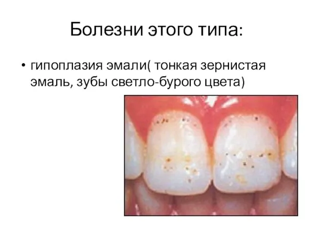 Болезни этого типа: гипоплазия эмали( тонкая зернистая эмаль, зубы светло-бурого цвета)