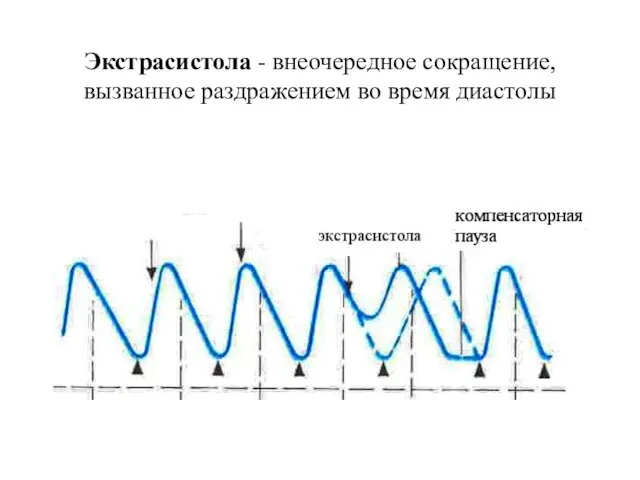 Экстрасистола - внеочередное сокращение, вызванное раздражением во время диастолы