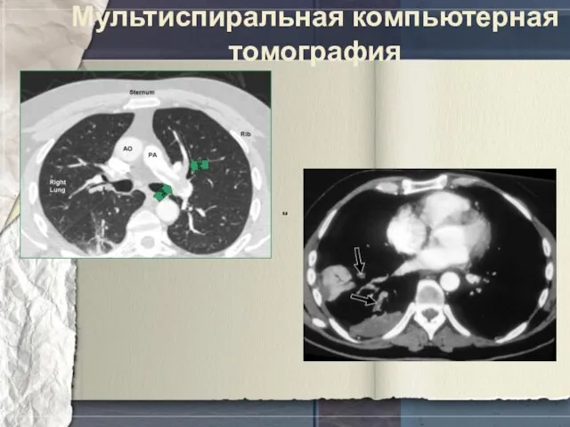 Мультиспиральная компьютерная томография