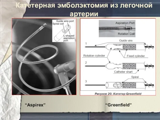 Катетерная эмболэктомия из легочной артерии “Aspirex” “Greenfield”