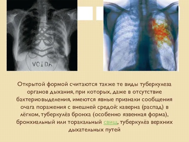 Открытой формой считаются также те виды туберкулеза органов дыхания, при которых, даже