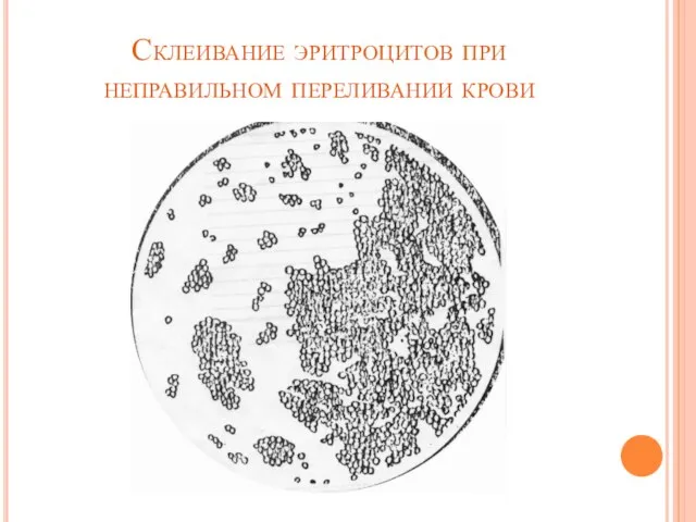 Склеивание эритроцитов при неправильном переливании крови