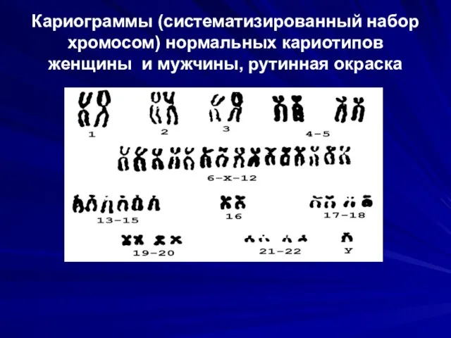 Кариограммы (систематизированный набор хромосом) нормальных кариотипов женщины и мужчины, рутинная окраска