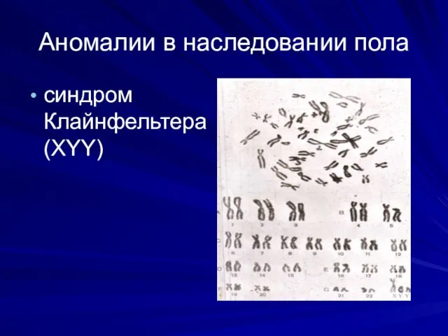 Аномалии в наследовании пола синдром Клайнфельтера (XYY)