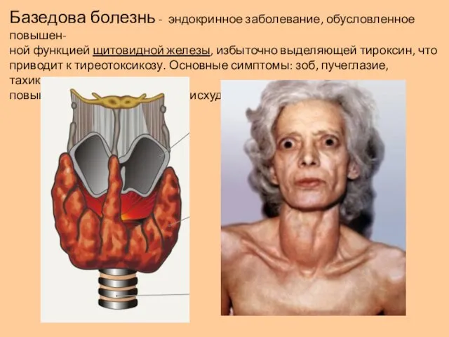 Базедова болезнь - эндокринное заболевание, обусловленное повышен- ной функцией щитовидной железы, избыточно