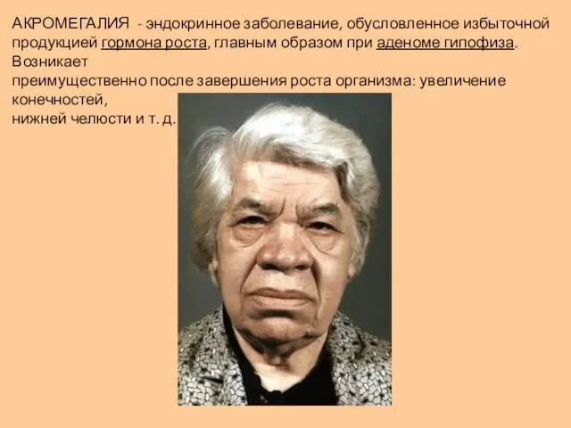 АКРОМЕГАЛИЯ - эндокринное заболевание, обусловленное избыточной продукцией гормона роста, главным образом при